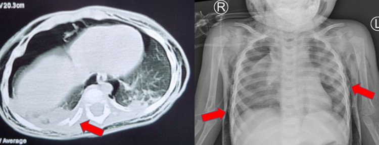 CT scan và Xquang phổi cho thấy trẻ bị tràn khí trung thất, tràn khí dưới da, gãy xương sườn - Ảnh BVCC