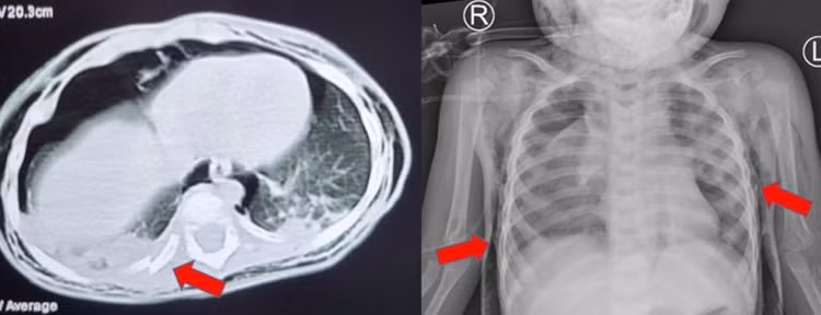 CT scan và Xquang phổi cho thấy trẻ bị tràn khí trung thất, tràn khí dưới da, gãy xương sườn - Ảnh BVCC