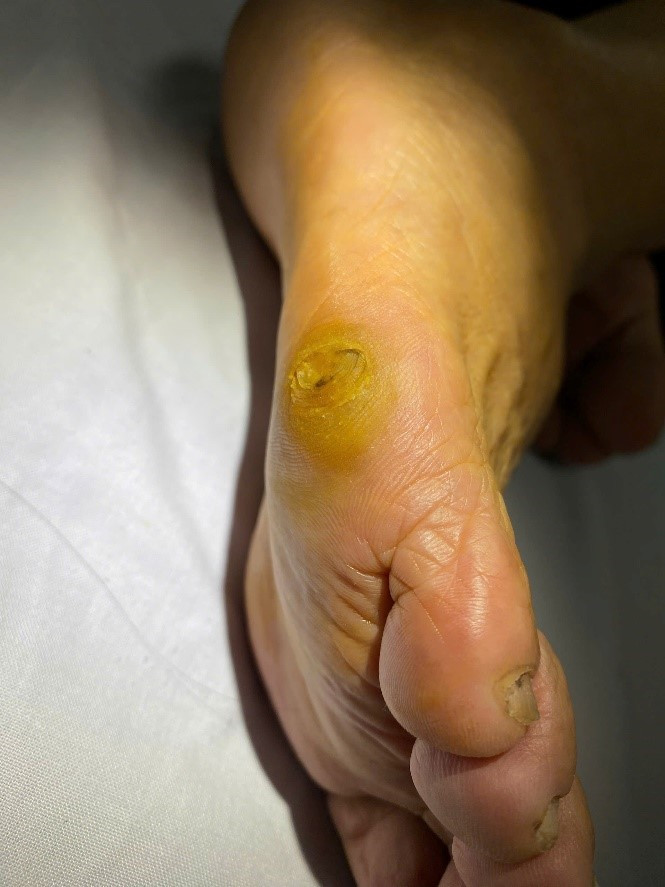 Bác sĩ mách cách chăm sóc và điều trị chai chân ảnh 1