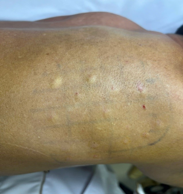 Tiêm Botulinum toxin - giải pháp mới trong điều trị đau sau zona - Ảnh BSCC