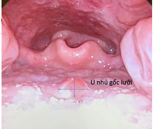 Hình ảnh u nhú gốc lưỡi ở bệnh nhi trên phim chụp - Ảnh BSCC