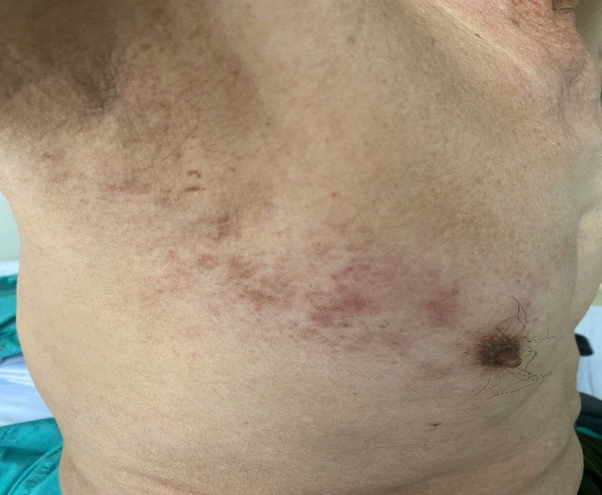 Tổn thương bệnh nhân đau sau zona vùng liên sườn ngực phải - ảnh BVCC