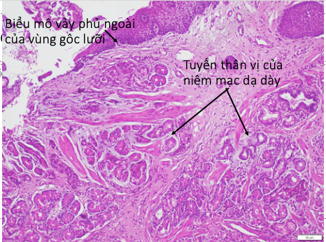 Hình ảnh mô bệnh học niêm mạc thân vị dạ dày của u gốc lưỡi - Ảnh BSCC