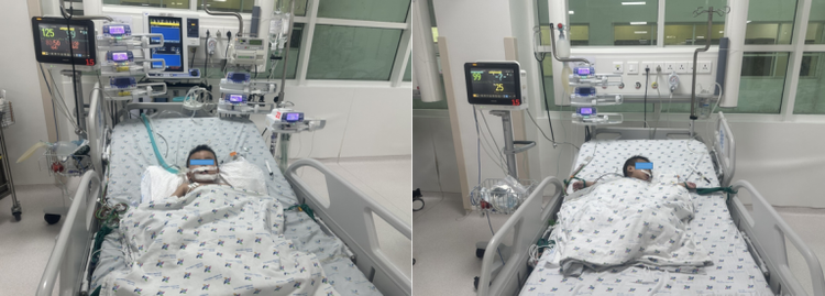 Sau gần 2 tuần điều trị phẫu thuật khâu vỡ khí quản, tình trạng trẻ cải thiện, phục hồi, tỉnh táo, cai máy thở khí trời - Ảnh BVCC