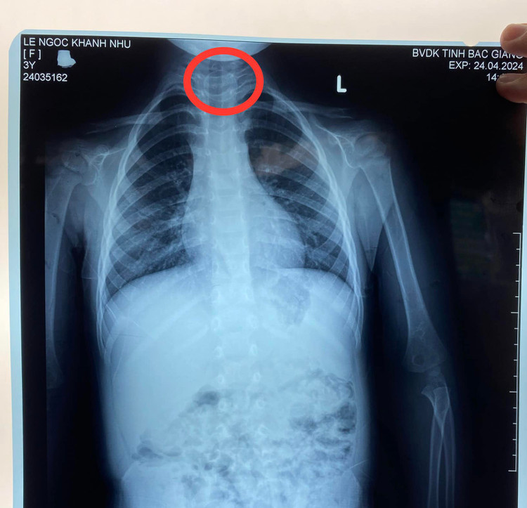 Đồng xu trong thực quản bé gái - Ảnh: BVCC
