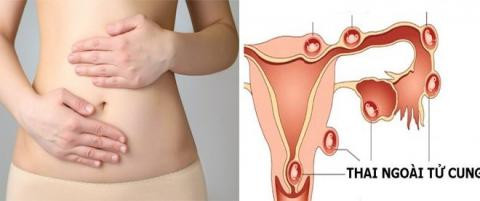 Dấu hiệu làm tổ của thai ngoài tử cung