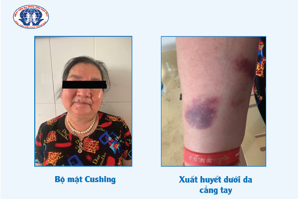 Tự dùng thuốc trị đau khớp bị biến chứng suy tuyến thượng thận nguy kịch