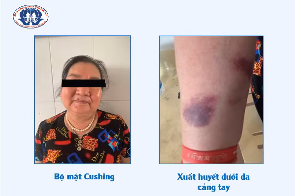 Tự dùng thuốc trị đau khớp bị biến chứng suy tuyến thượng thận nguy kịch Tự dùng thuốc trị đau khớp bị biến chứng suy tuyến thượng thận nguy kịch