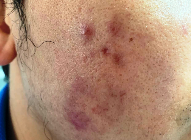 Chàng trai bị tổn thương da sau tiêm meso