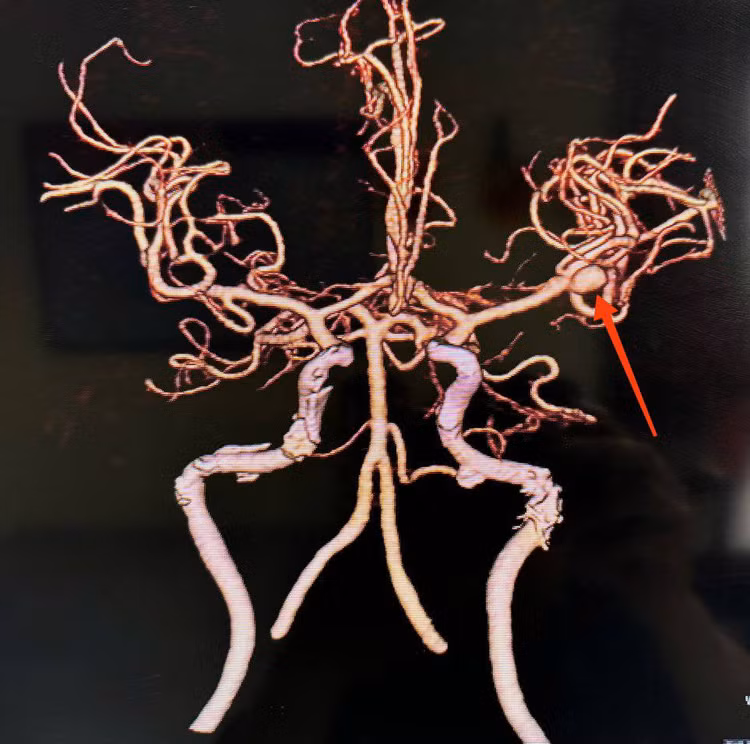 Vỡ túi phình mạch não - Ảnh BVCC