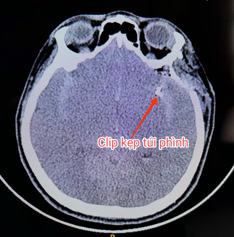Clip kẹp túi phình mạch máu não - Ảnh BVCC Clip kẹp túi phình mạch máu não - Ảnh BVCC
