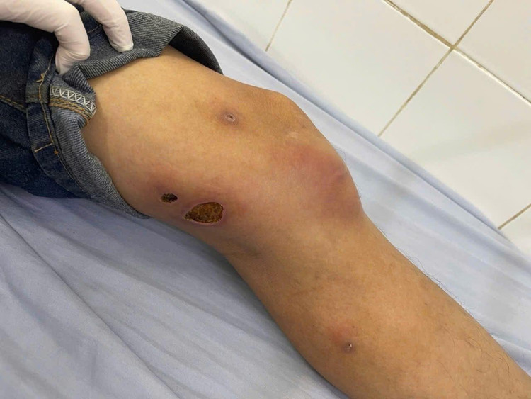 Ổ áp xe của giun rồng - Ảnh BVCC