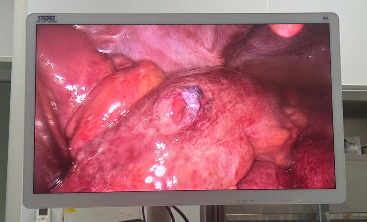 Hình ảnh thủng ruột trên nội soi - Ảnh BVCC