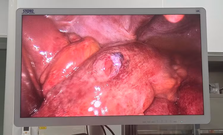 Hình ảnh thủng ruột trên nội soi - Ảnh BVCC