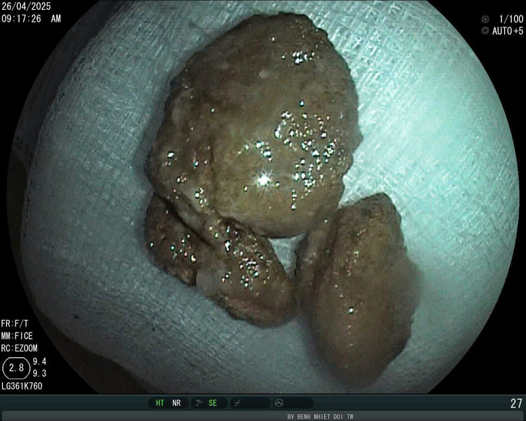 Khối bã thức ăn đã được lấy ra - Ảnh BVCC