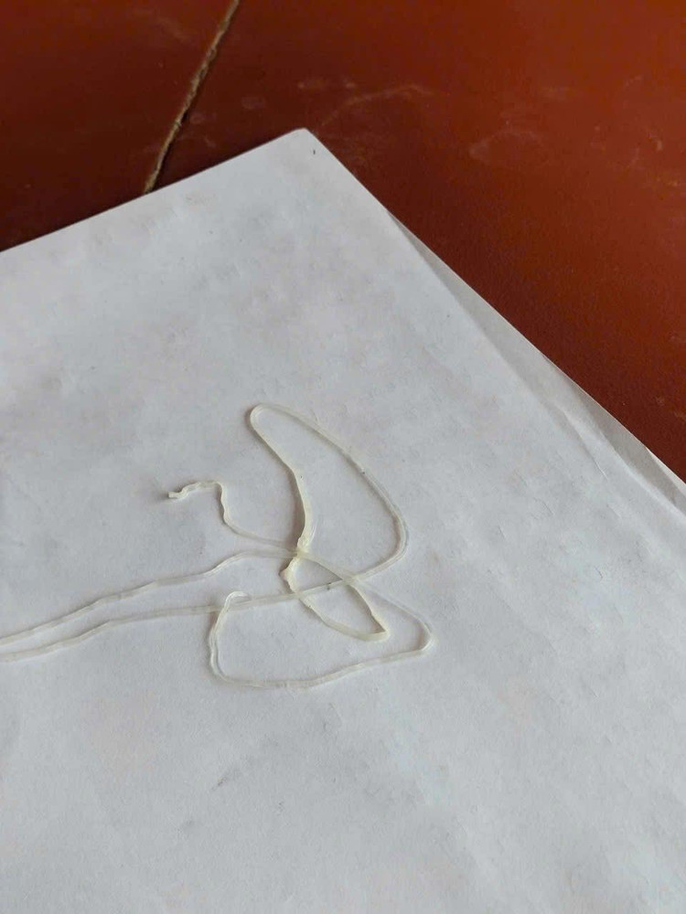 Giun rồng dài hơn 1 m được lấy ra - Ảnh BVCC