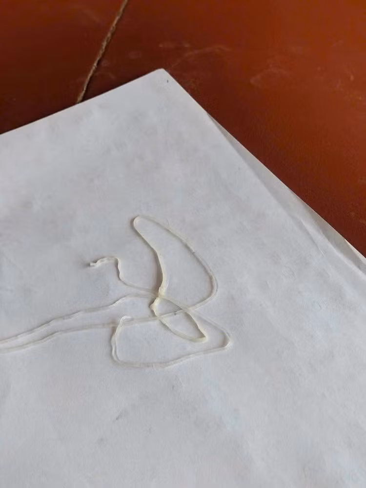 Giun rồng dài hơn 1 m được lấy ra - Ảnh BVCC