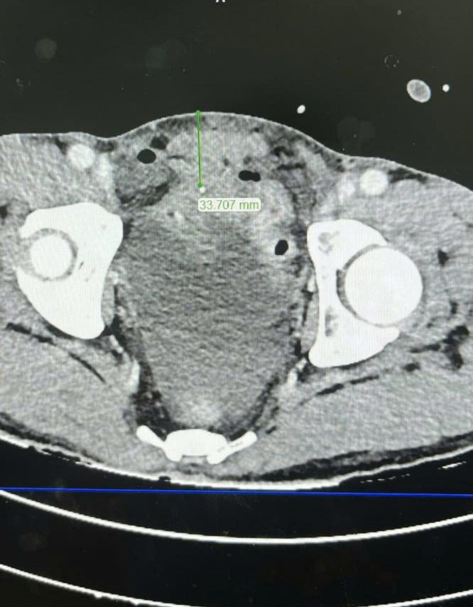 Đang cắt cỏ, người đàn ông bị viên sỏi nhỏ bắn xuyên bụng gây thủng ruột ảnh 2