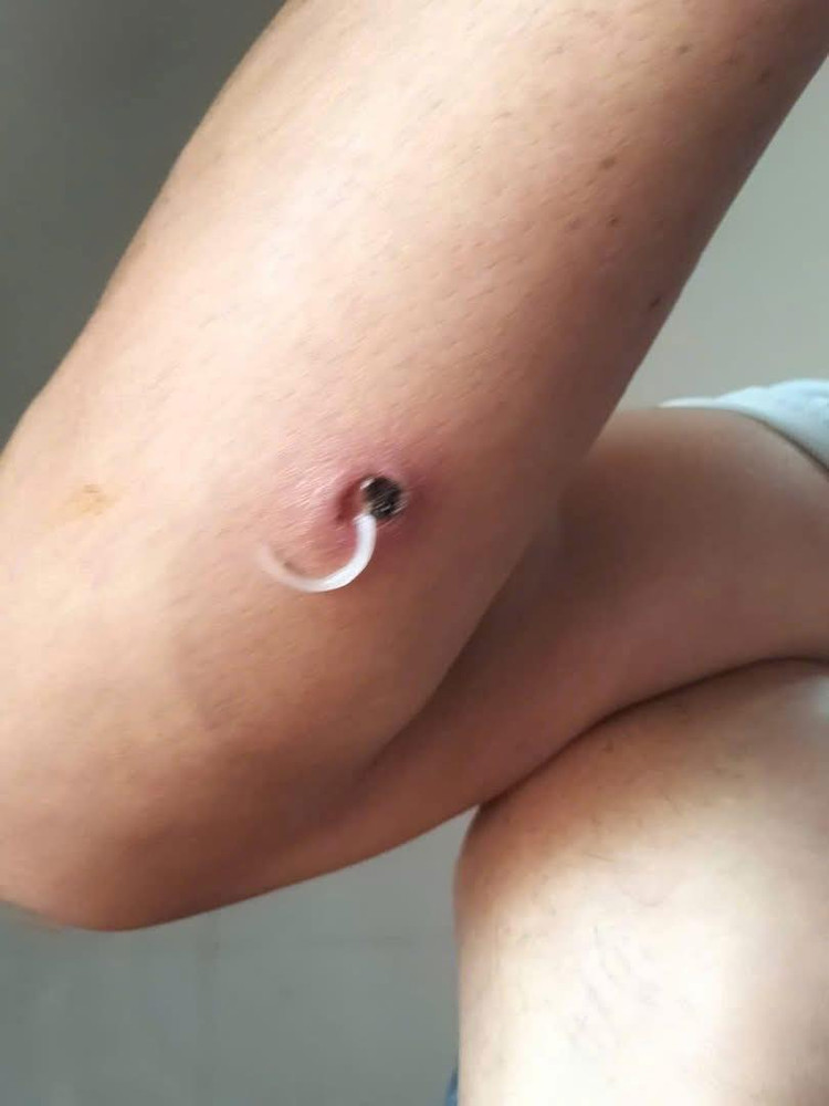 Giun rồng đang chui ra - Ảnh BVCC