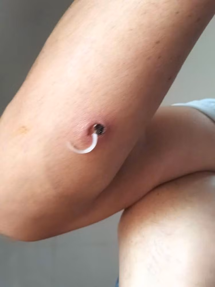 Giun rồng đang chui ra - Ảnh BVCC