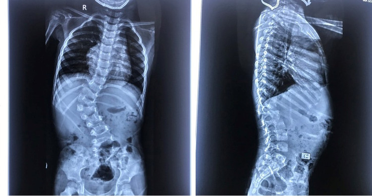 Hình X quang cong vẹo cột sống - Ảnh BVCC