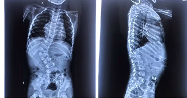 Hình X quang cong vẹo cột sống - Ảnh BVCC