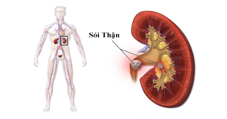 Biểu hiện của sỏi thận - Ảnh minh họa nguồn Internet
