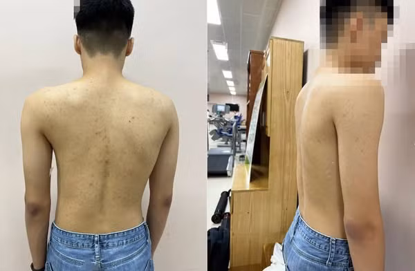 Gù vẹo cột sống ảnh hưởng nghiêm trọng tới sự phát triển của trẻ - Ảnh BVCC