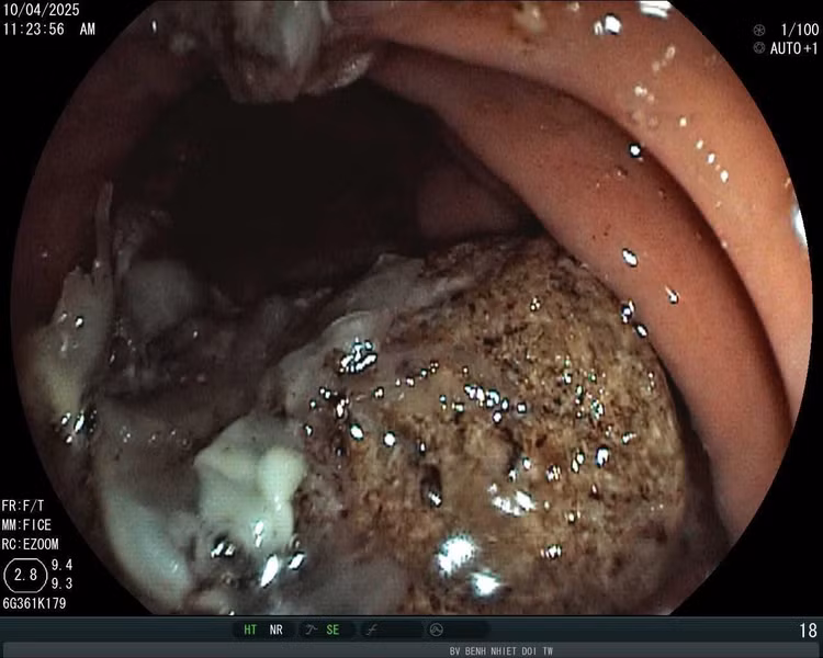 Bã thức ăn chứa đầy trong dạ dày - Ảnh BVCC