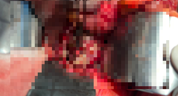 Lỗ thủng trực tràng sau thụt cà phê qua hậu môn - Ảnh BSCC