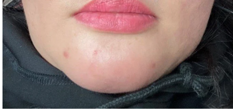 Tiêm Filler cằm cô gái bị nhiễm trùng: dịch, mủ chảy trong khoang miệng - Ảnh BVCC