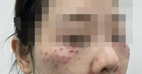 Nhiều người gặp tai biến vì làm đẹp bằng tế bào gốc - Ảnh minh hoạ