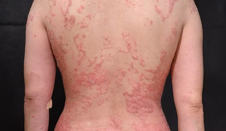 Cách phòng tránh khởi phát và tăng nặng bệnh vẩy nến - Ảnh minh hoạ