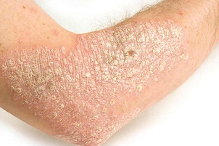 Bệnh vẩy nến - Ảnh minh họa