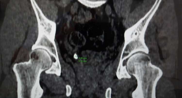 Sỏi thận trong cơ thể người bệnh trên phim chụp - Ảnh BVCC