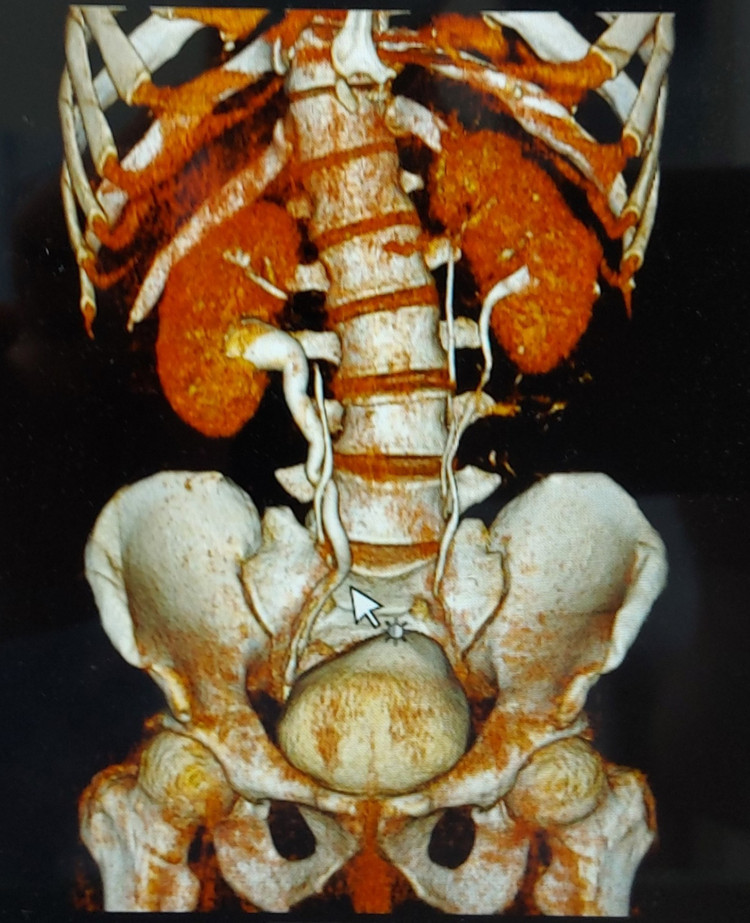 Hình ảnh thận của bệnh nhân trên phim chụp - Ảnh: BVCC