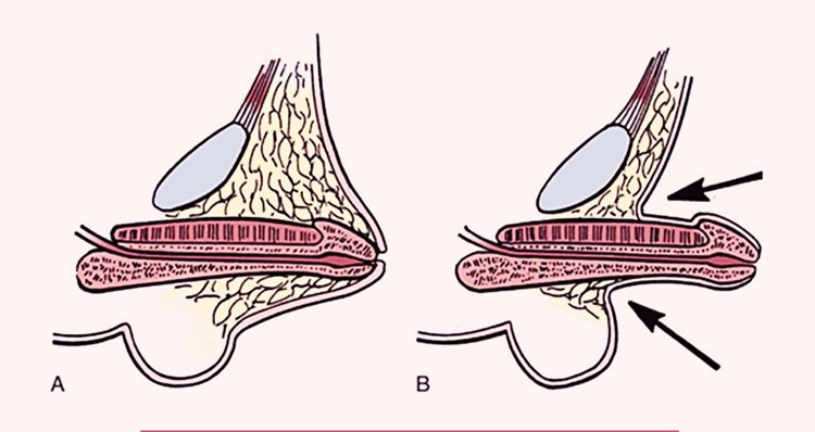Bác sĩ mách cách phát hiện và điều trị vùi dương vật bẩm sinh ở trẻ ảnh 1 Bác sĩ mách cách phát hiện và điều trị vùi dương vật bẩm sinh ở trẻ ảnh 1