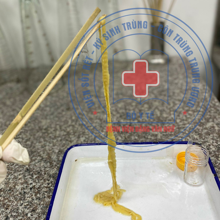 Hy hữu: Người phụ nữ 40 tuổi đi ngoài ra sán 1,5m ảnh 2