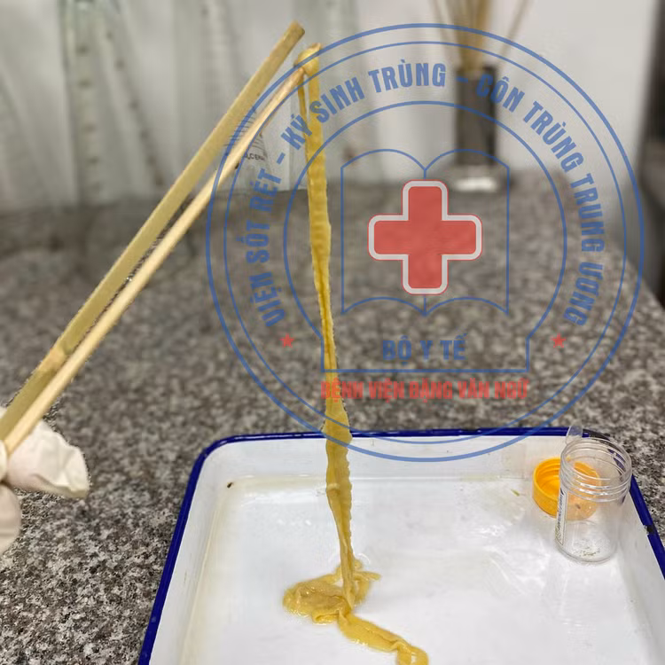 Hy hữu: Người phụ nữ 40 tuổi đi ngoài ra sán 1,5m ảnh 2