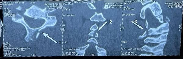 Hình ảnh chấn thương cột sống cổ trên phim chụp - Ảnh BVCC