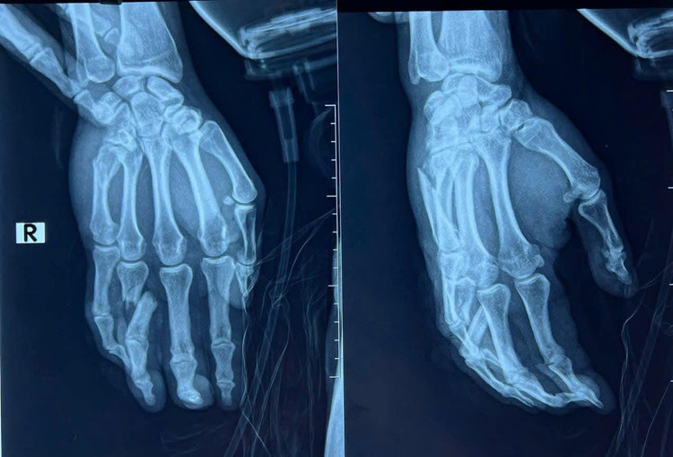 Hình ảnh tổn thương xương bàn tay và ngón tay - Ảnh BVCC