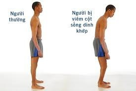 Biểu hiện của đau lưng do viêm cột sống dính khớp - Ảnh minh họa