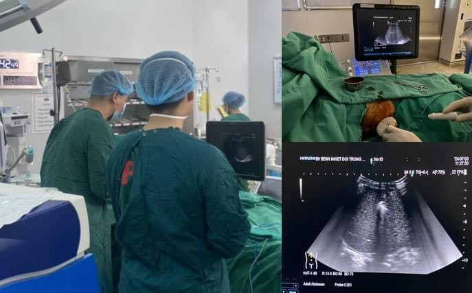 Ca phẫu thuật cho bệnh nhân ung thư gan - Ảnh BVCC