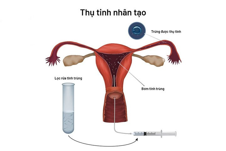 Điều kiện để tiến hành thụ tinh nhân tạo ảnh 1
