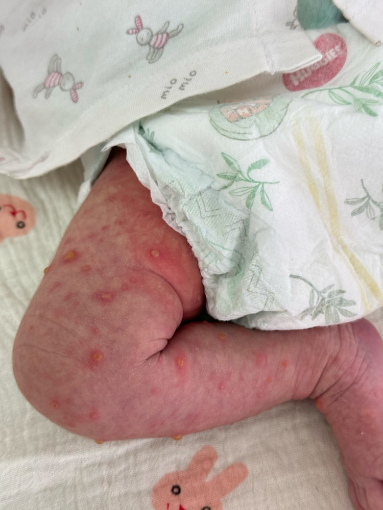 Trẻ sơ sinh bị thủy đậu Trẻ sơ sinh bị thủy đậu