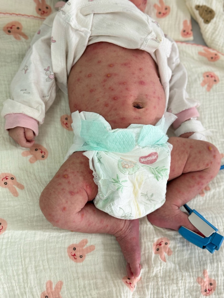 Trẻ sơ sinh bị thủy đậu lây nhiễm từ mẹ Trẻ sơ sinh bị thủy đậu lây nhiễm từ mẹ