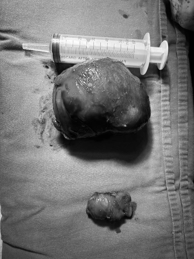 Khối u tinh hoàn ẩn được lấy ra - Ảnh BVCC Khối u tinh hoàn ẩn được lấy ra - Ảnh BVCC