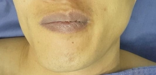 Triệu chứng co giật nửa mặt - Ảnh BSCC