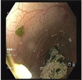 Ảnh nội soi phát hiện vùng co thắt tâm vị - Ảnh BVCC