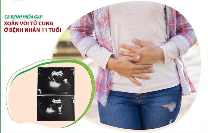 Hiếm gặp trường hợp xoắn vòi tử cung ở bệnh nhân 11 tuổi - Ảnh minh hoạ